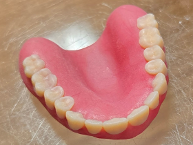 3Dプリンター作成の義歯